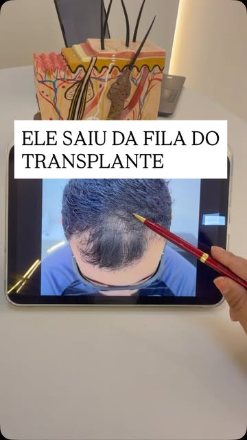 Mais um paciente que saiu da fila do transplante capilar.

Mesmo com a área frontal bastante avançad
