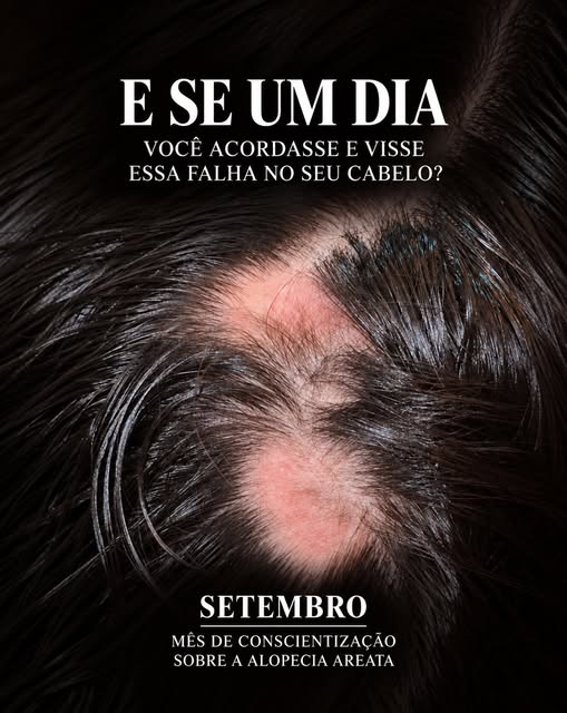 Setembro é o mês de conscientização sobre a alopecia areata.

Este mês existe para informar, combate