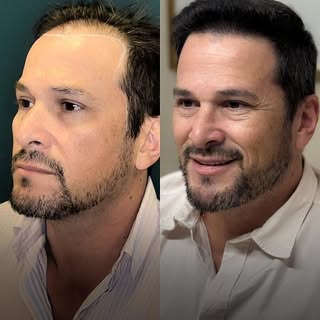 "Além de estética, mudou meu trabalho."

O Murillo já vivia atrás das câmeras por conta do trabalho,