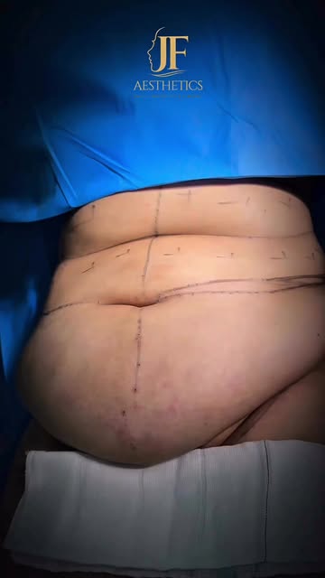 360° Lipo + Mini Tummy Tuck
Comprehensive contouring with skin tightening for a flatter, firmer, mor