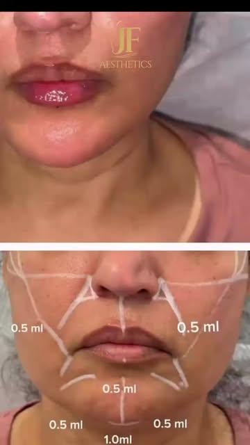 Lift. Define. Slim.

3 mL Filler + 100 Units Lower Face Botox — strategically placed to sculpt the j