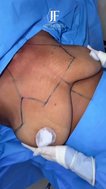 Reshape. Lift. Restore.

Complete breast contouring at JF Aesthetics. Our combined reduction, lift, 