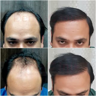 Witness the incredible transformation of a hair restoration journey. 🌟✨
HAIR TRANSPLANT is a blend 