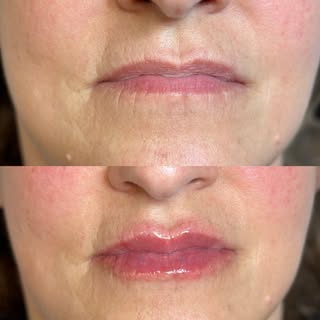 Filler labbra: prima e dopo ✨

La dottoressa Gloria Finulli ci spiega com’è andata ad intervenire su
