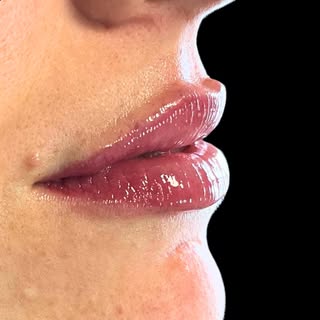 Filler labbra: il risultato 💉

Chiamaci o scrivici su Whatsapp per prenotare la tua prima visita di