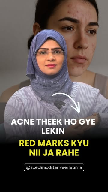 Your pimple is gone, but that red mark is still there? 🔴 That's not acne anymore — it's PIE (Post-I