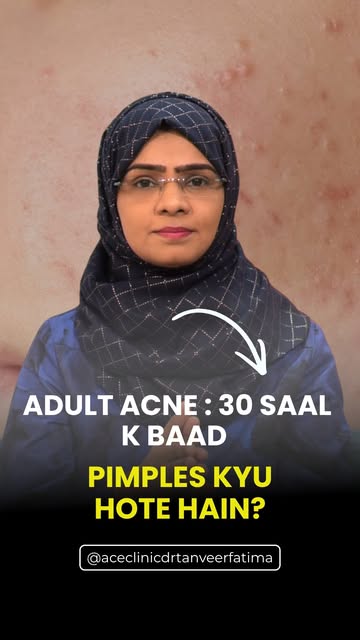 Skin Specialist in Roorkee getting pimples after 30? It’s more common than you think! 

Adult acne c