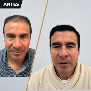 ¡De la pérdida de cabello a una melena llena de confianza! ✨ Mira esta increíble transformación capi