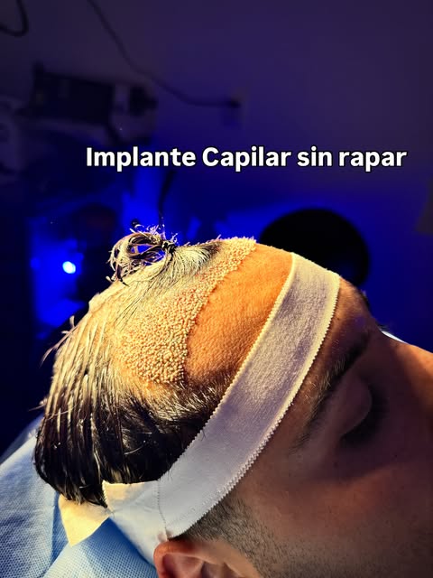 Implante capilar sin necesidad de rapar @lumos_chile