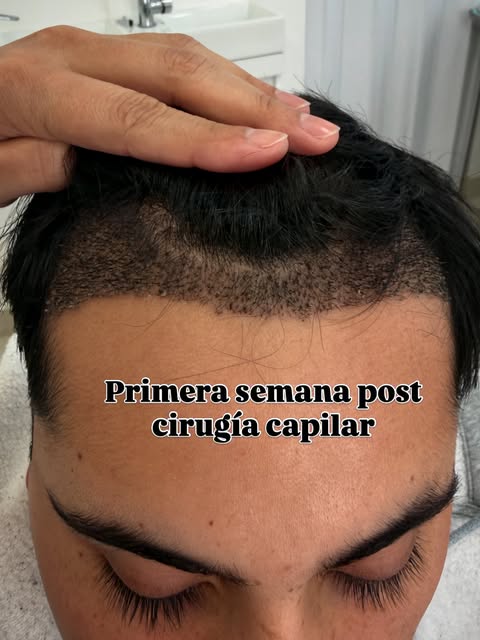 ✨ Evolución de nuestro paciente tras su implante capilar

Un proceso que requiere tiempo, constancia