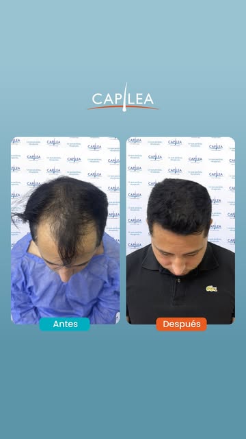 Antes evitaba las fotos de frente.

Hoy ya no evita el espejo.

Ese es el verdadero antes y después: