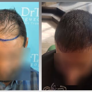 Hair Transplant Course
Hair Transplant training courses are hands-on and tailor-made for the attende