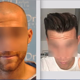 Hair Transplant Course
Hair Transplant training courses are hands-on and tailor-made for the attende
