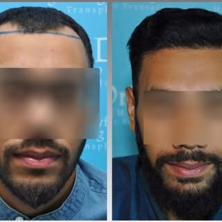 Hair Transplant Course
Hair Transplant training courses are hands-on and tailor-made for the attende