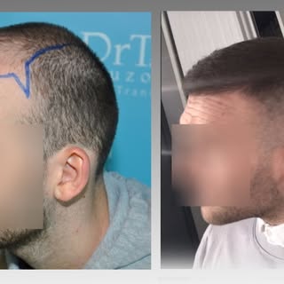 Hair Transplant Course
Hair Transplant training courses are hands-on and tailor-made for the attende