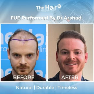 At 9 months post hair transplant, the result shows a strong, natural hairline with excellent density