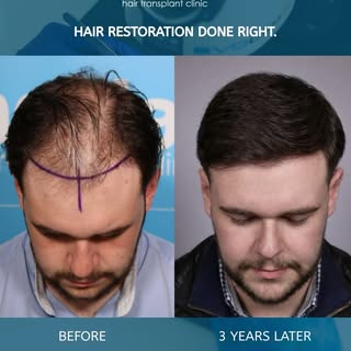 Three years later — and the results still look this good. ⏳✨

A great hair transplant isn’t just abo