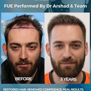 3 years later… and still going strong.

This hair transplant was performed by Dr Fas Arshad FRCS, Co