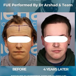 Four years later… and the results are still going strong 💫

This hair transplant was carried out by