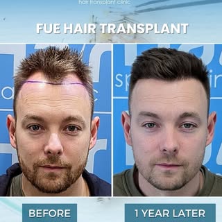 This 1900-graft hair transplant at 12 months shows the power of precision and expert technique - per