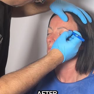 Interested in eyebrow transplants? 👀

Today’s case: Nikki came in for an eyebrow transplant at The 