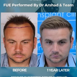 One year later… and the result speaks for itself 💫

This hair transplant was carried out by Dr Fas 