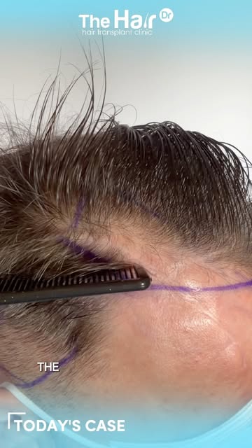 Today’s case at The Hair Dr is a reconstructive FUE hair transplant following previous trauma surger