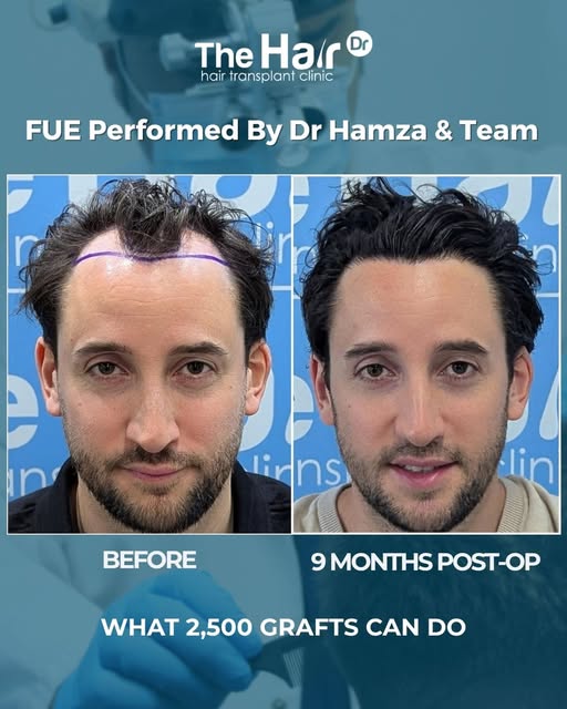 Nine months later… and the results are really starting to shine.

This FUE hair transplant was carri