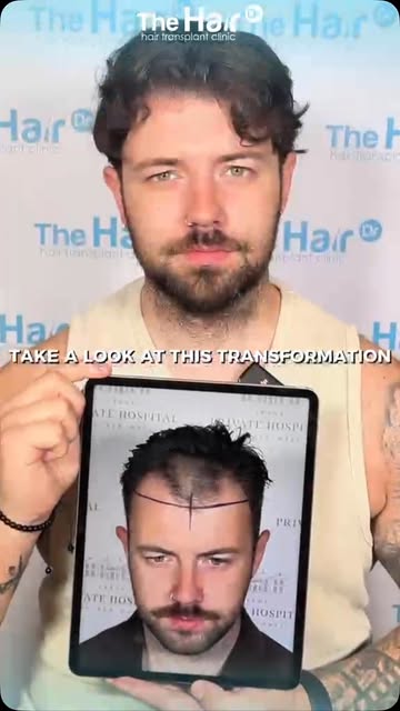 What is it really like to have a hair transplant? 👀

For many patients, the decision to undergo a h