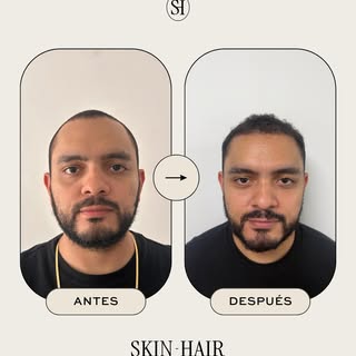 Resultados de 4 meses, trasplante capilar. Resultados reales, procesos bien hechos.

Este antes y de