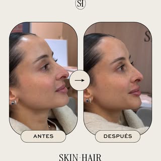 Aplicación de ácido hialurónico en labios 👄 

Así se ve un antes y después en SkinHair. 
Resultados