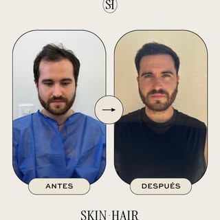 5 meses Postrasplante capilar!!.
Cada resultado empieza mucho antes del procedimiento.

Diagnóstico,