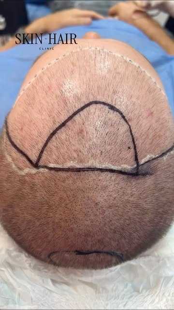 Un implante capilar no se trata simplemente de recuperar cabello. Se trata de conseguir que se vea n