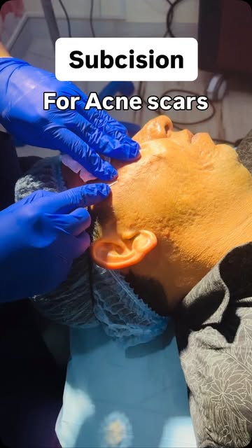 Subcision for acne scars

Subcision is a minimally invasive scar-release procedure in which a needle