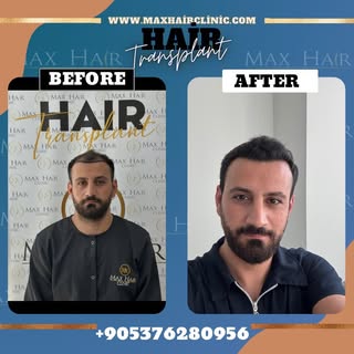 Yeni bir görünüm, yeni bir özgüven. ✨
Max Hair Clinic’te gerçekleştirilen saç ekimi operasyonumuzun 