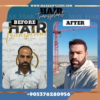 Yeni bir görünüm, yeni bir özgüven. ✨
Max Hair Clinic’te gerçekleştirilen saç ekimi operasyonumuzun 