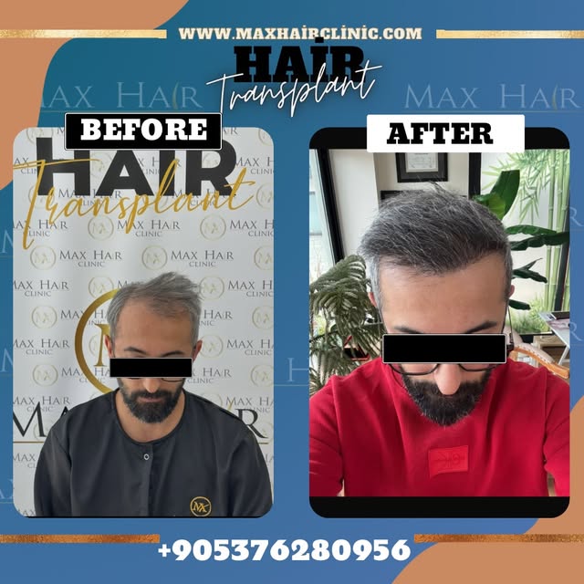 Saç Ekimi Öncesi & Sonrası | Max Hair Clinic

Doğal ve sık bir saç ekimi arıyorsan orası maxhairclin