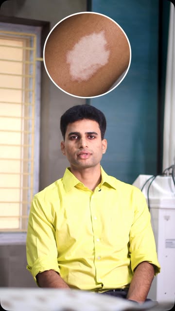 ప్రతి తెల్ల మచ్చ కుష్ఠి వ్యాధి కాదు..! ❌
చర్మంపై తెల్లటి మచ్చలు కనిపిస్తే వెంటనే భయపడాల్సిన అవసరం లే
