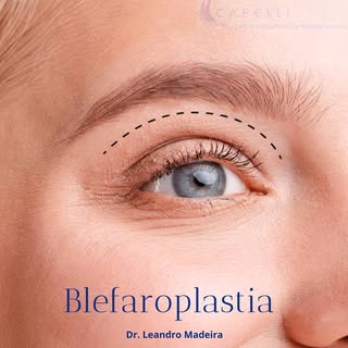A blefaroplastia é uma cirurgia plástica que consiste na retirada do excesso de pele das pálpebras i