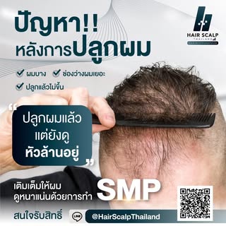 📣📣 #ปลูกผมมาแล้วแต่ยังดูหัวล้านอยู่😓 
..
✔️กราฟท์ผมขึ้นไม่แน่น ✔️ช่องว่างของเส้นผมห่าง
✔️เห็นหนัง