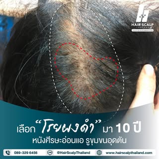#การโรยผงดำ⚫️ เป็นอีกหนึ่งทางเลือกของการปกปิด #ปัญหาศรีษะล้าน ที่หลายๆคนเลือกใช้ แต่จะปกปิดได้เพียงช