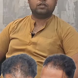 Grade 4 Baldness •••••••••••••••••••••••••••••••••••••••••••••••••
📞Call us at 7049069691/704906965