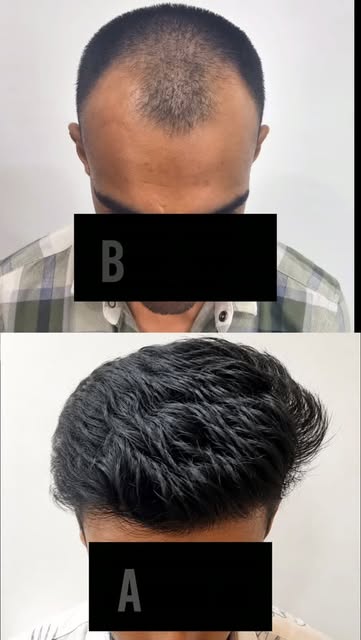 Grade 4 Baldness •••••••••••••••••••••••••••••••••••••••••••••••••
📞Call us at 7049069691/704906965