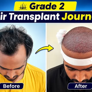 Grade 2 Baldness •••••••••••••••••••••••••••••••••••••••••••••••••
📞Call us at 7049069691/704906965