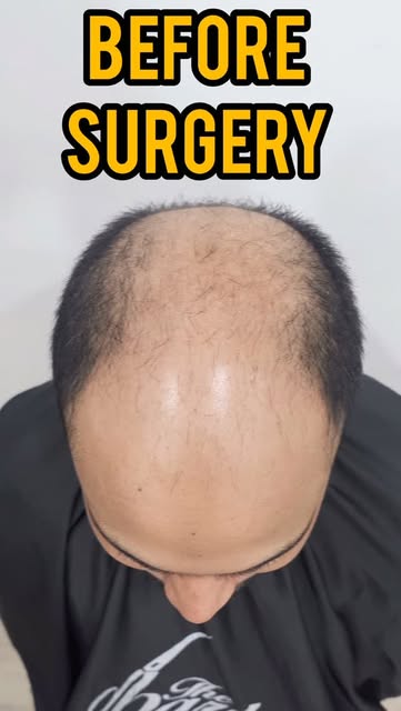 Grade 6 Baldness •••••••••••••••••••••••••••••••••••••••••••••••••
📞Call us at 7049069691/704906965