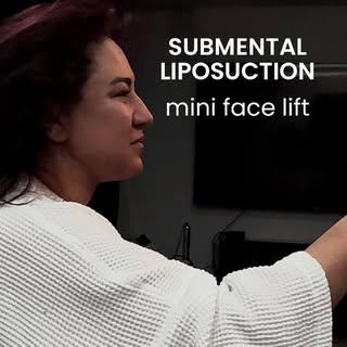 In just two hours, we achieved a remarkable reduction in the submental (under-chin) area—completely 