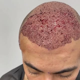 #1hairtransplant