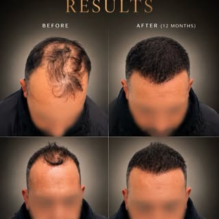 12 months. One transformation. A completely different relationship with his hair.

Restored density,