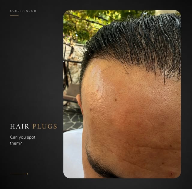 Swipe for more information!! 
A hair transplant should be designed to blend naturally with the patie