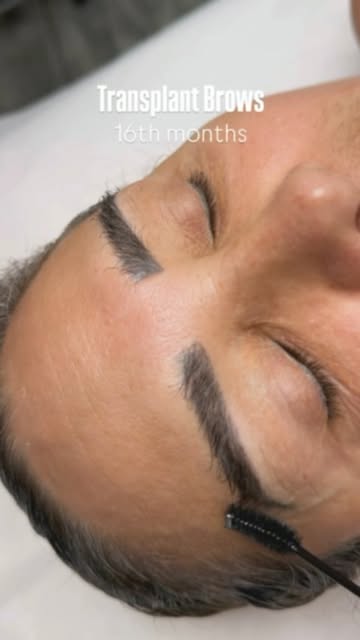16 months later—and the results speak for themselves. ✨

A beautifully restored eyebrow with natural